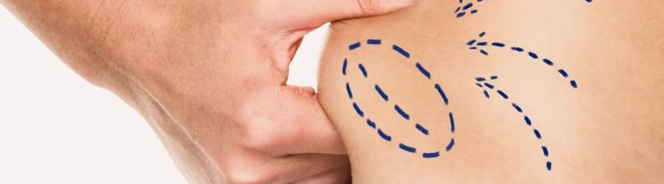 Liposuction Surgery